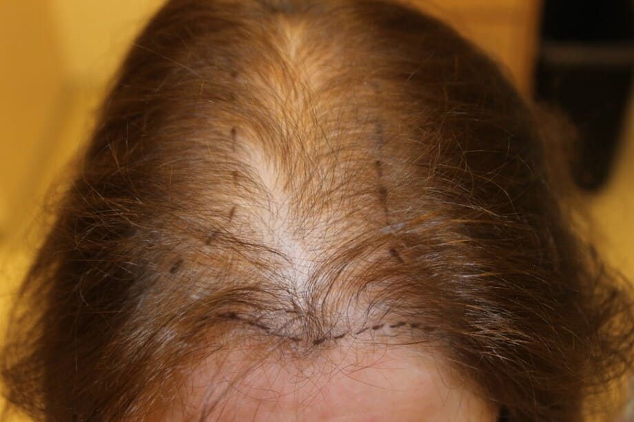 Är du en av många kvinnor som drabbats av tillfälligt håravfall?