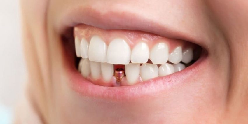 Varför ersätta saknade tänder med tandimplantat?