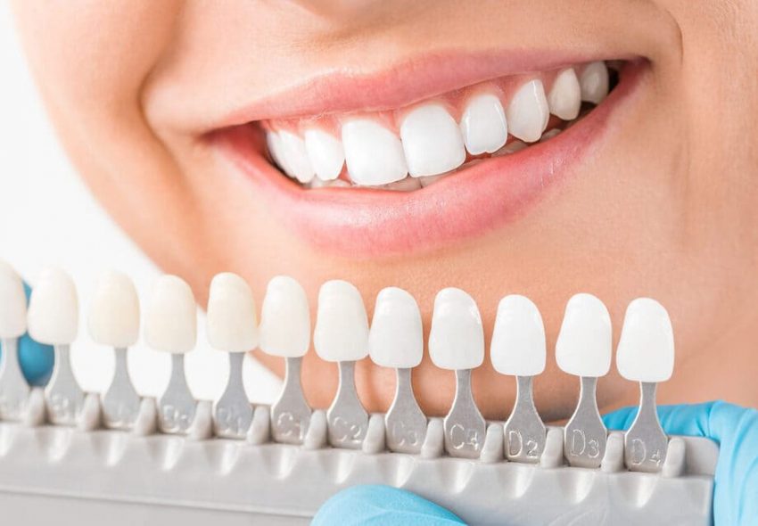 Vita tänder professionellt eller direkt på nätet?